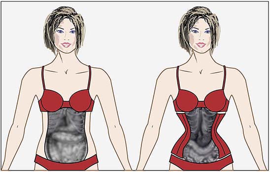 Fig. 1. The impact of a corset